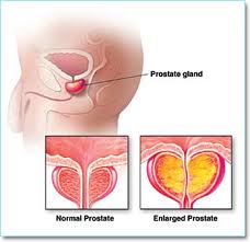 Prostate Enlargement + side effects of testosterone injections