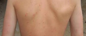 body acne in men