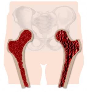 1. Degrading Bone Health