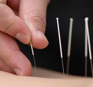 5 Acupuncture