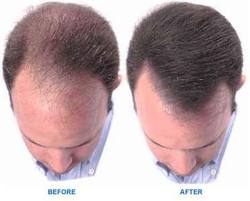 hair growth products + men + receding hairline
