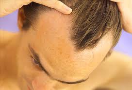 receding hairline treatments for men