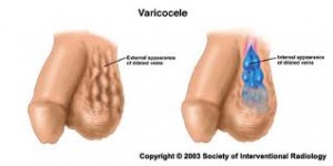 Varicocele