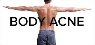 body acne