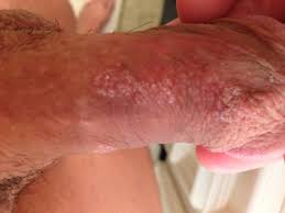 Dermatitis + dry skin on penis