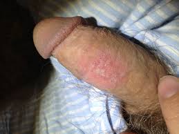 Eczema (Psoriasis) + dry skin on penis