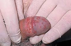 Herpes + dry skin on penis