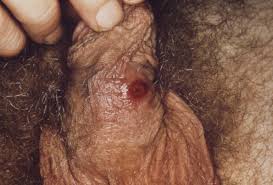 Syphilis + dry skin on penis