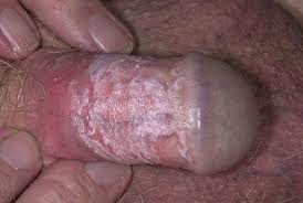 Yeast Infection + dry skin on penis